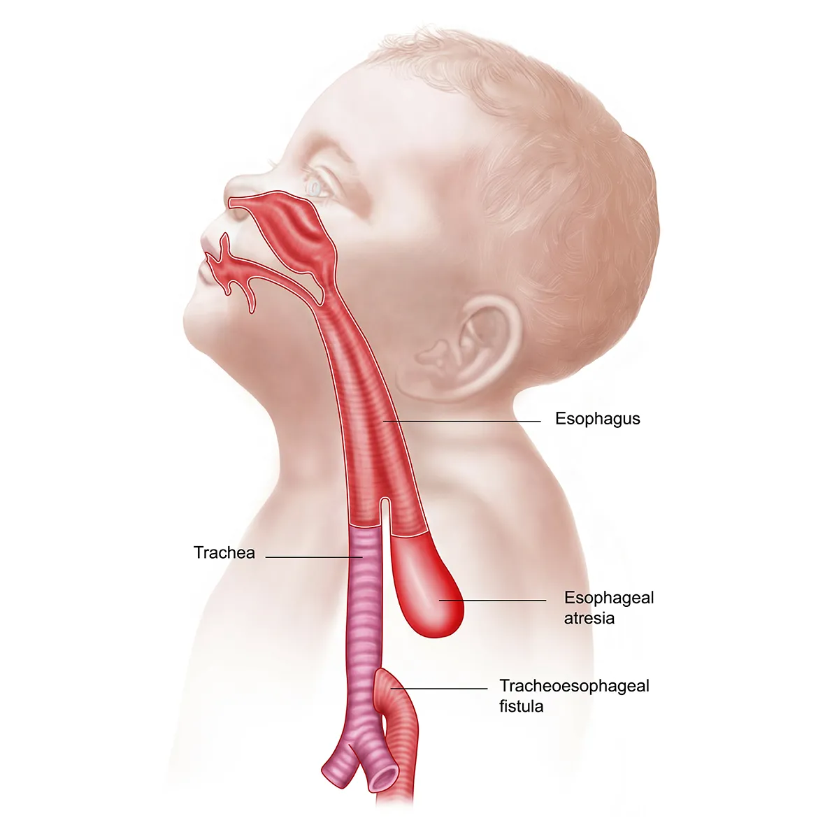 Illustration of a newborn's head and upper body, displaying the esophagus and trachea. The esophagus is divided, with the upper portion ending in a pouch (esophageal atresia) and the lower portion connecting to the trachea through an abnormal passage (tracheoesophageal fistula). Labels identify the esophagus, trachea, esophageal atresia, and tracheoesophageal fistula.