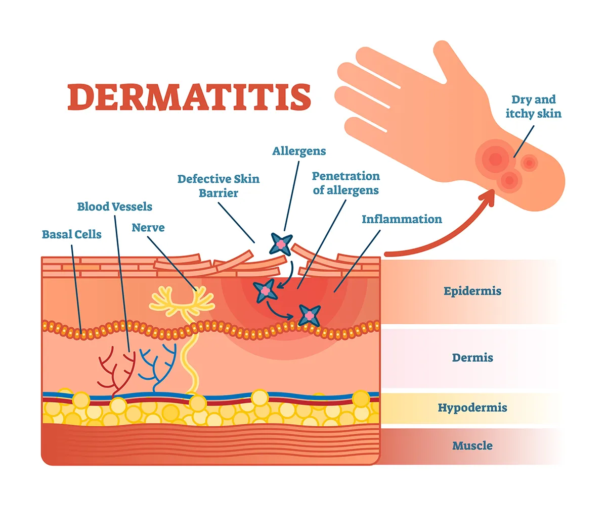 A cross-sectional diagram shows the skin affected by dermatitis. Allergens penetrate a defective skin barrier in the epidermis, causing inflammation. An inset shows an arm with red, irritated spots, indicating dry and itchy skin.