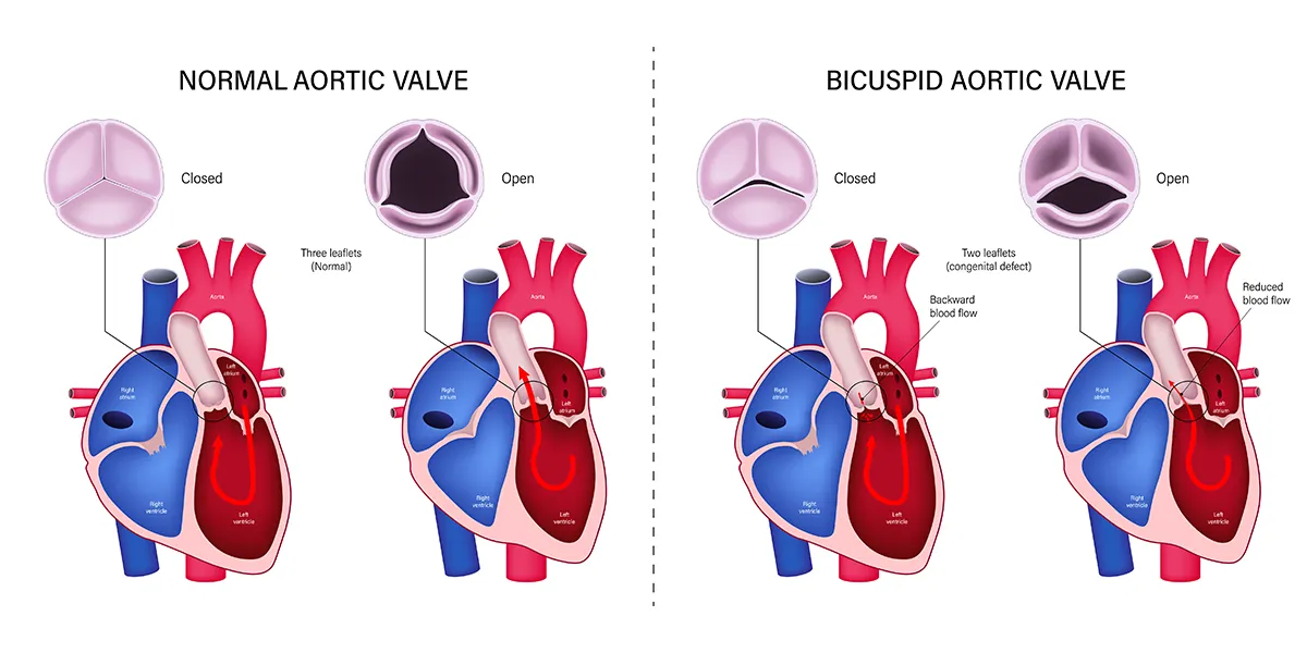 Image shows how blood flows through the atria and ventricles (chambers of the heart) with a normal aortic valve and how blood flow may be affected by a bicuspid aortic valve.