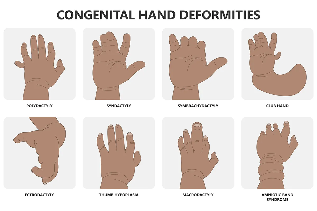 Congenital Hand Deformities Advocate Children s Hospital Chicago IL Congenital Hand Deformities Advocate Children s Hospital Chicago IL