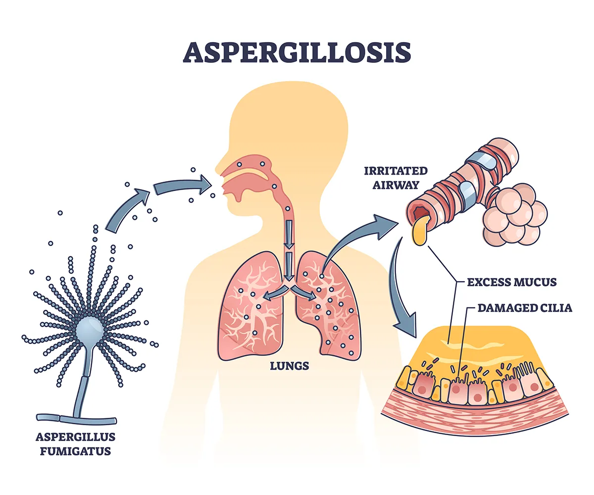 An illustration showing how aspergillus fumigatus spores can cause aspergillosis, leading to irritated airways, excess mucus and damaged cilia in the lungs.