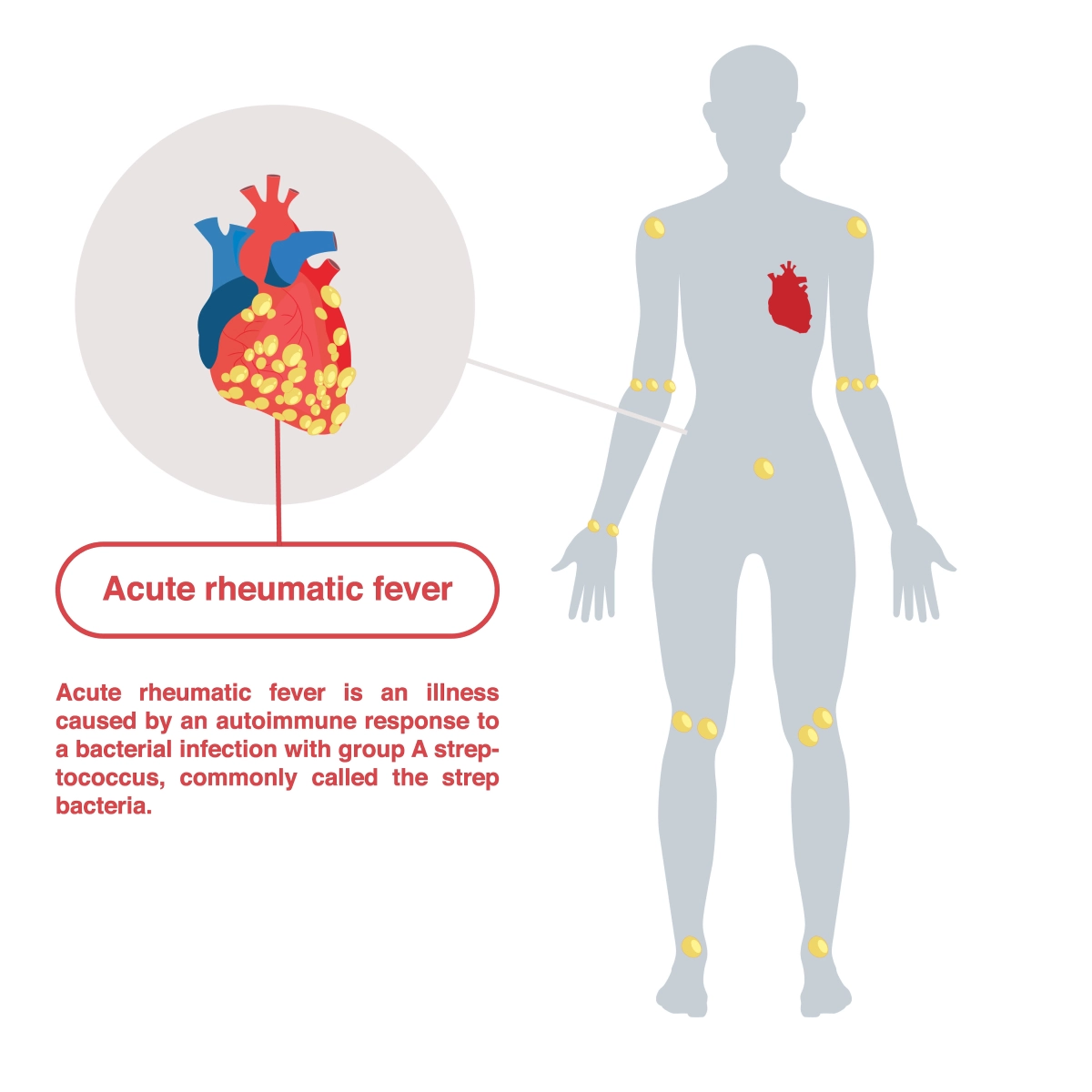Illustration of a human figure highlighting areas affected by acute rheumatic fever, including joints and the heart, with a close-up of the heart showing inflammation around the heart. The text explains that acute rheumatic fever is caused by an autoimmune response to group A streptococcus infection.