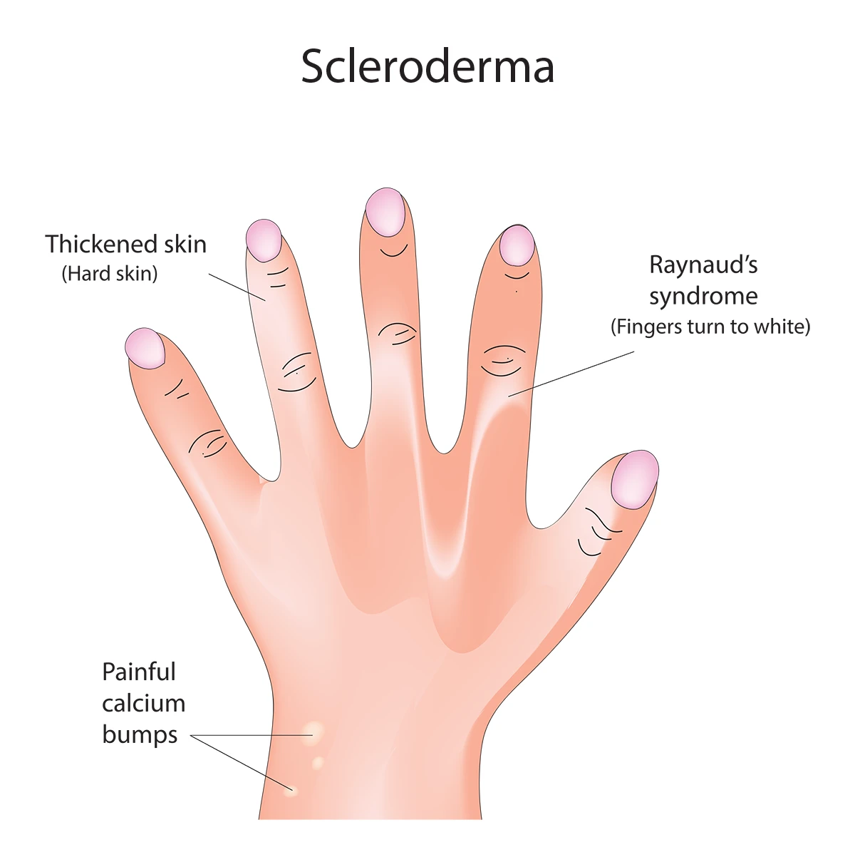 An illustration of a hand with scleroderma symptoms, including thickened, hard skin, fingers turning white due to Raynaud’s syndrome, and painful calcium deposits on the skin.