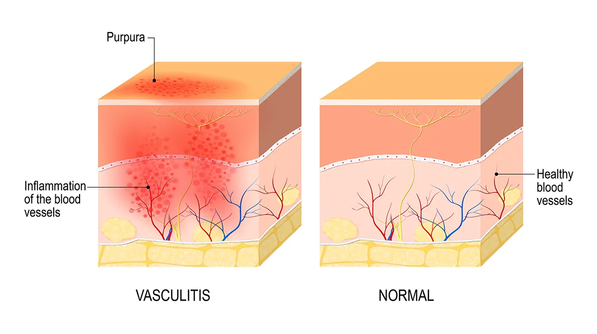 The image shows purpura – a rash that often occurs with vasculitis – compared to healthy skin.