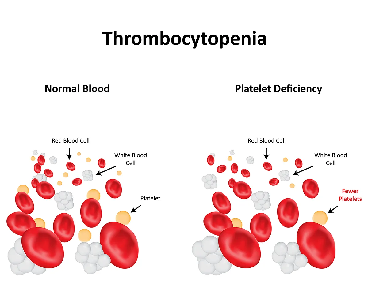 A side-by-side illustration comparing normal blood cell levels and blood with low platelet levels (thrombocytopenia). The left panel shows red and white blood cells with enough platelets. The right panel shows fewer platelets alongside red and white blood cells.